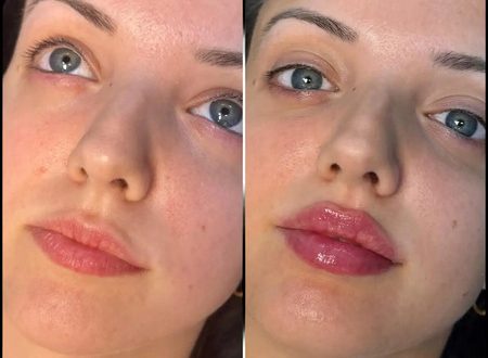 H5-lip-fillers (1) (1) (2) (1)