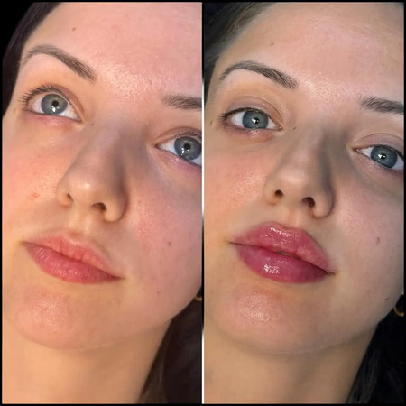 H5-lip-fillers (1) (1) (2) (1)